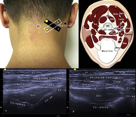 Botulinum neurotoxin injections for muscle.
